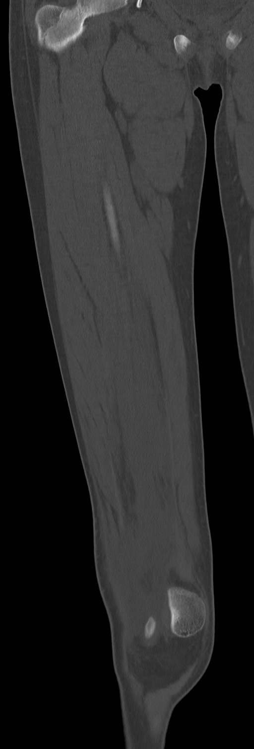 Chronic ostemyelitis of the femur with long sinus tract (Radiopaedia 74947-85982 Coronal bone window 31).jpg