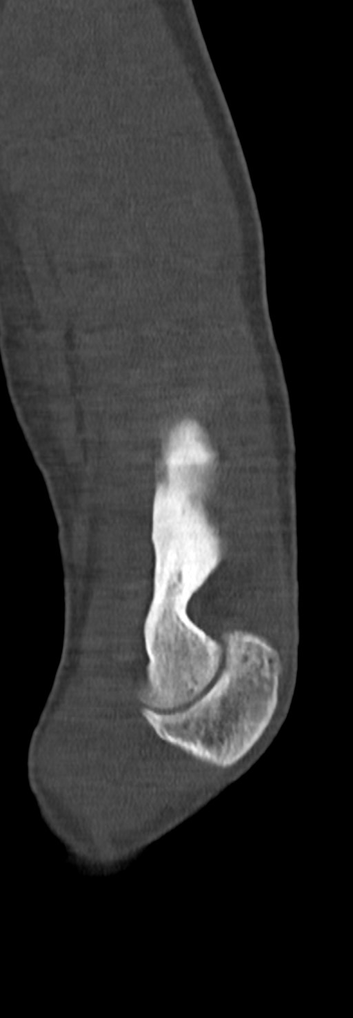 Chronic osteomyelitis of the distal humerus (Radiopaedia 78351-90971 Sagittal bone window 57).jpg