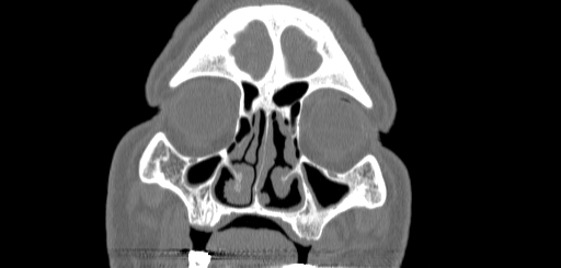 Chronic sphenoidal sinusitis (Radiopaedia 62030-70122 Coronal bone window 32).jpg