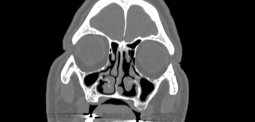 File:Chronic sphenoidal sinusitis (Radiopaedia 62030-70122 Coronal bone window 40).jpg