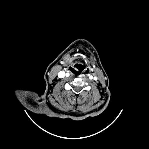 File:Chronic submandibular abscess (Radiopaedia 21738-21718 A 31).jpg