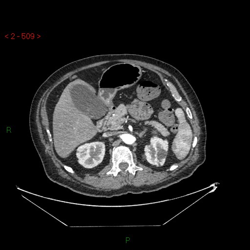 File:Circumaortic left renal vein and doubled left renal arteries (Radiopaedia 52268-58158 A 45).jpg