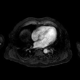 Cirrhosis and hepatocellular carcinoma in the setting of hemochromatosis (Radiopaedia 75394-86594 Axial T1 C+ fat sat 170).jpg