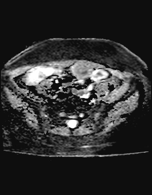File:Class II Mullerian duct anomaly- unicornuate uterus with rudimentary horn and non-communicating cavity (Radiopaedia 39441-41755 Axial ADC 5).jpg