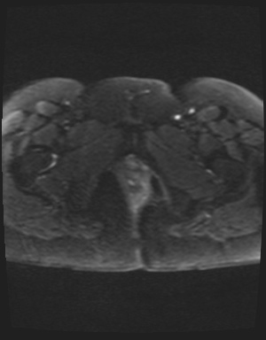 Class II Mullerian duct anomaly- unicornuate uterus with rudimentary horn and non-communicating cavity (Radiopaedia 39441-41755 Axial DWI 27).jpg