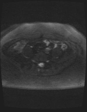 Class II Mullerian duct anomaly- unicornuate uterus with rudimentary horn and non-communicating cavity (Radiopaedia 39441-41755 Axial DWI 33).jpg