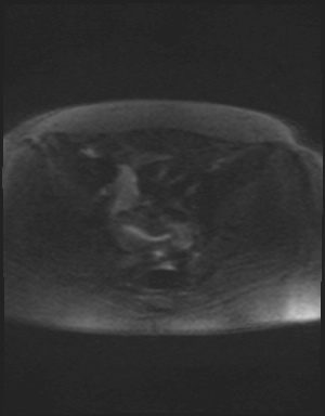 Class II Mullerian duct anomaly- unicornuate uterus with rudimentary horn and non-communicating cavity (Radiopaedia 39441-41755 Axial DWI 79).jpg