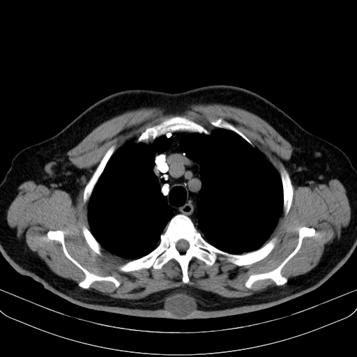 File:Classic complicated silicosis (Radiopaedia 49720-54961 Axial liver window 12).jpg