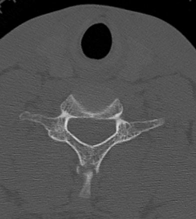 Clay-shoveler fracture (Radiopaedia 14604-14532 Axial bone window 26).jpg