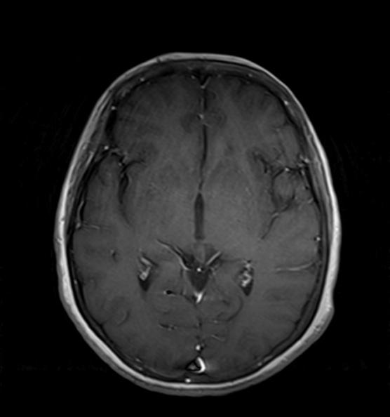 File:Clival meningioma (Radiopaedia 53278-59248 Axial T1 C+ 11).jpg