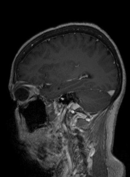 File:Clival meningioma (Radiopaedia 53278-59248 Sagittal T1 C+ 201).jpg