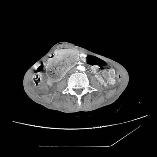 Closed-loop obstruction due to peritoneal seeding mimicking internal hernia after total gastrectomy (Radiopaedia 81897-95864 A 120).jpg