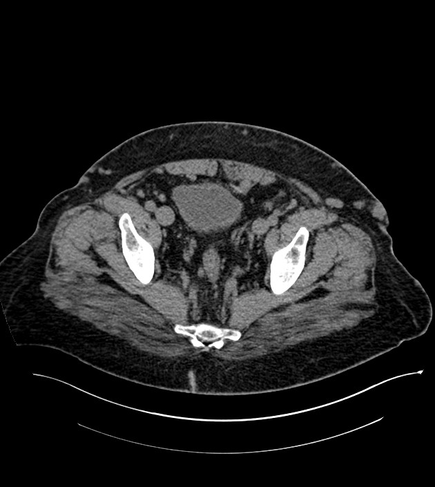 Closed-loop small bowel obstruction-internal hernia (Radiopaedia 78439-91096 Axial non-contrast 135).jpg