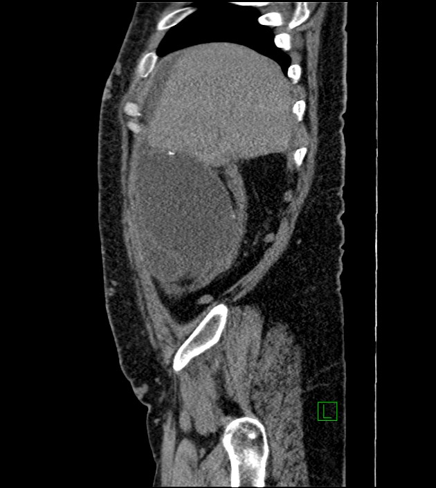 Closed-loop small bowel obstruction-internal hernia (Radiopaedia 78439-91096 C 120).jpg