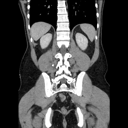 Closed-loop small bowel obstruction (Radiopaedia 73713-84509 C 93).jpg