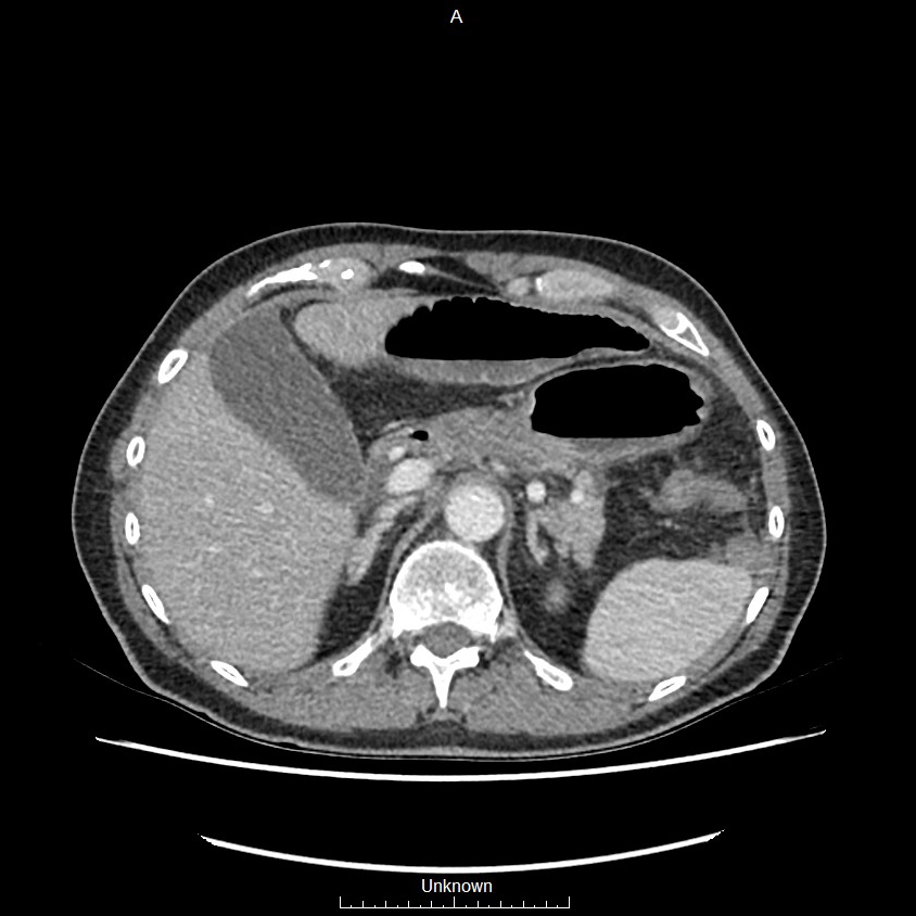 Closed loop bowel obstruction and ischemia (Radiopaedia 86959-103180 A 14).jpg