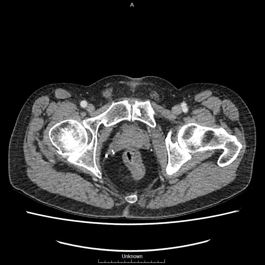 Closed loop bowel obstruction and ischemia (Radiopaedia 86959-103180 A 88).jpg