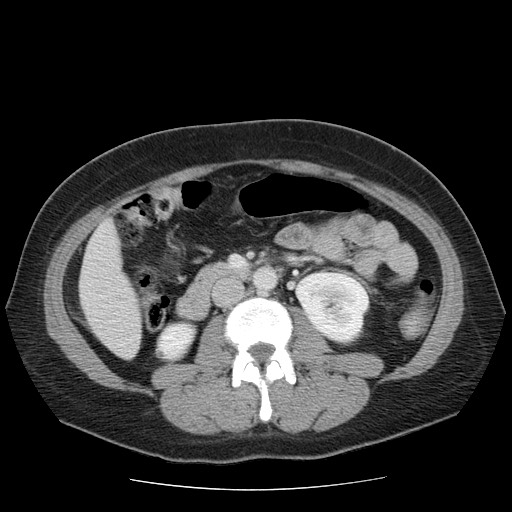 File:Closed loop small bowel obstruction (Radiopaedia 65403-74451 A 38).jpg