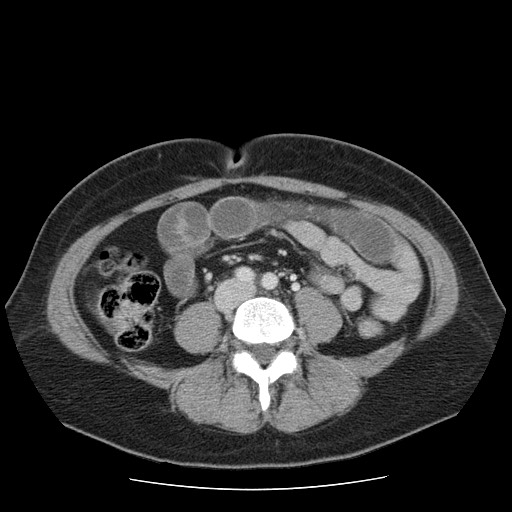 File:Closed loop small bowel obstruction (Radiopaedia 65403-74451 A 48).jpg