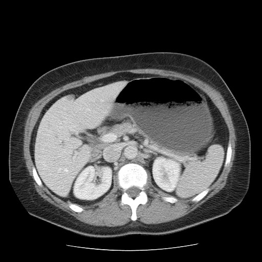 File:Closed loop small bowel obstruction (Radiopaedia 65403-74451 Axial 45).jpg