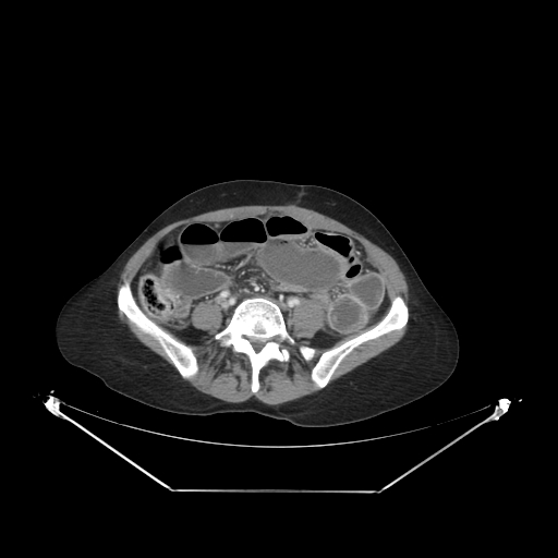 Closed loop small bowel obstruction (Radiopaedia 68471-78022 A 46).jpg