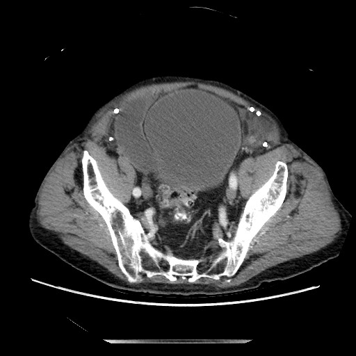 Closed loop small bowel obstruction - adhesive disease and hemorrhagic ischemia (Radiopaedia 86831-102990 A 146).jpg