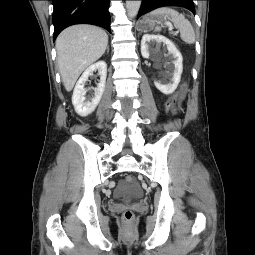 Closed loop small bowel obstruction - omental adhesion causing "internal hernia" (Radiopaedia 85129-100682 B 90).jpg