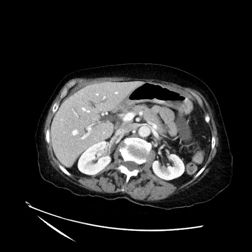 File:Closed loop small bowel obstruction due to adhesive band, with intramural hemorrhage and ischemia (Radiopaedia 83831-99017 Axial 61).jpg