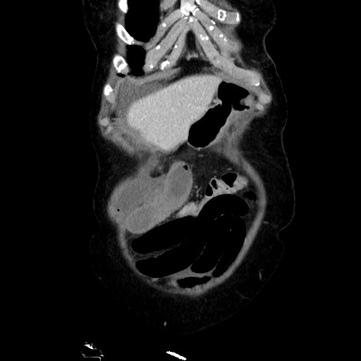 Closed loop small bowel obstruction due to adhesive band, with intramural hemorrhage and ischemia (Radiopaedia 83831-99017 C 24).jpg