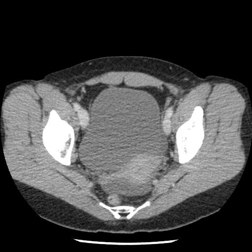 File:Closed loop small bowel obstruction due to trans-omental herniation (Radiopaedia 35593-37109 A 76).jpg