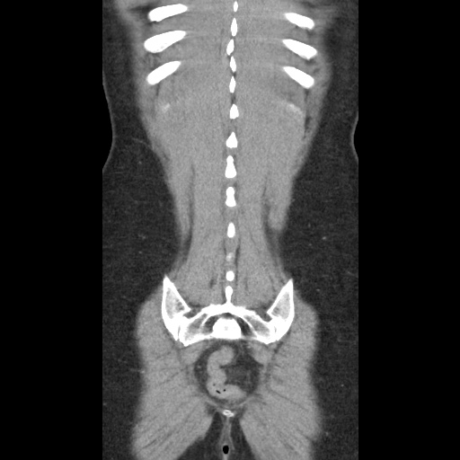 File:Closed loop small bowel obstruction due to trans-omental herniation (Radiopaedia 35593-37109 B 47).jpg