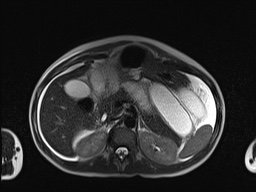 File:Closed loop small bowel obstruction in pregnancy (MRI) (Radiopaedia 87637-104031 Axial T2 21).jpg