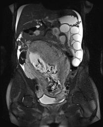 File:Closed loop small bowel obstruction in pregnancy (MRI) (Radiopaedia 87637-104031 Coronal T2 fat sat 30).jpg