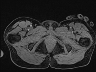 File:Closed loop small bowel obstruction in pregnancy (MRI) (Radiopaedia 87637-104031 G 34).jpg