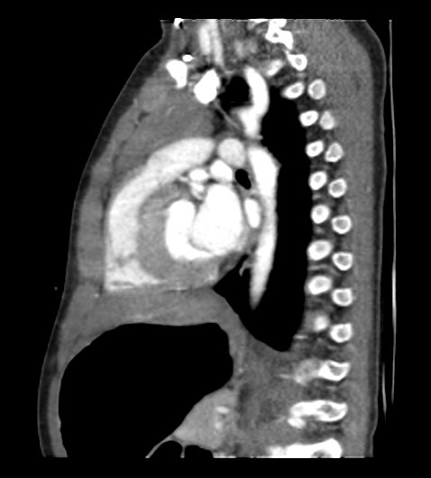 Coarctation of aorta (Radiopaedia 27427-27622 Sagittal C+ CTPA 80).png