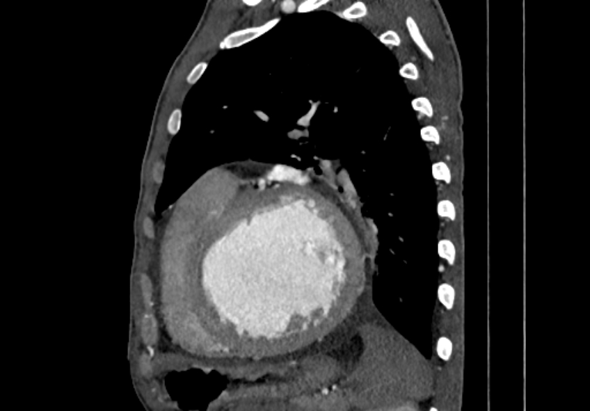 Coarctation of aorta with aortic valve stenosis (Radiopaedia 70463-80574 B 139).jpg