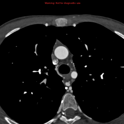 File:Coarctation of the aorta (Radiopaedia 12461-12697 A 108).jpg