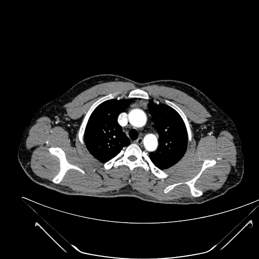 Coarctation of the aorta (Radiopaedia 49784-55050 B 41).jpg