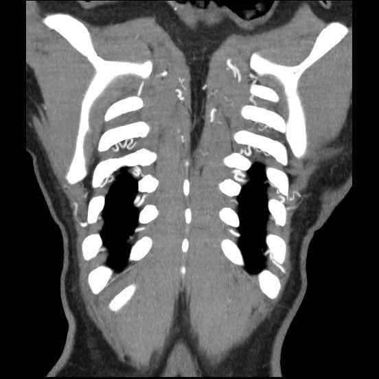 Coarctation of the aorta (Radiopaedia 67609-77010 B 7).jpg