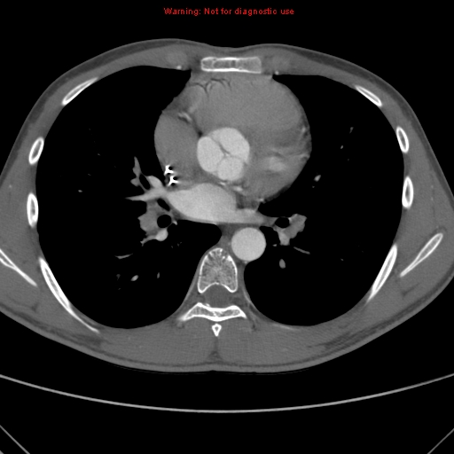 File:Coarctation of the aorta (Radiopaedia 9434-10118 A 101).jpg