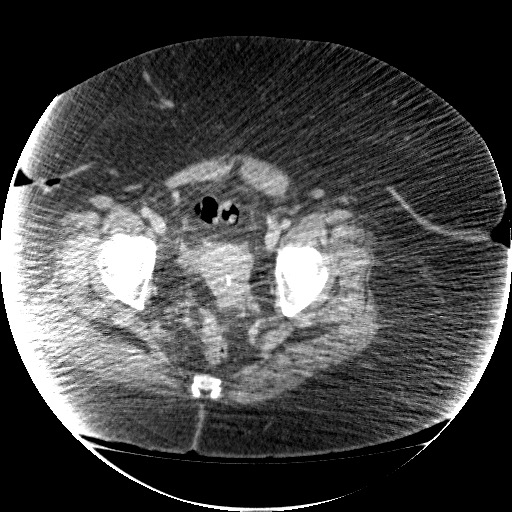 File:Collection due to leak after sleeve gastrectomy (Radiopaedia 55504-61972 A 73).jpg