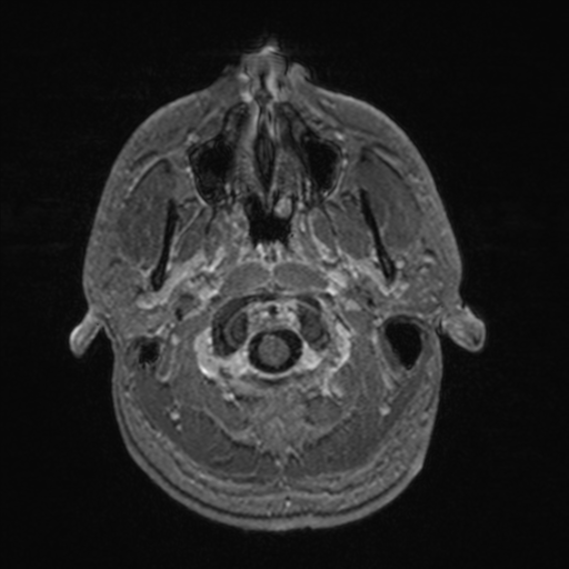 File:Colloid cyst (Radiopaedia 44510-48181 Axial T1 C+ 23).png