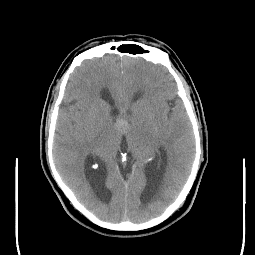 File:Colloid cyst (large) (Radiopaedia 34415-35734 Axial non-contrast 28).png