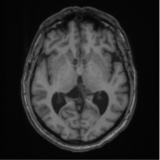 File:Colloid cyst of the third ventricle (Radiopaedia 86571-102662 Axial T1 38).png