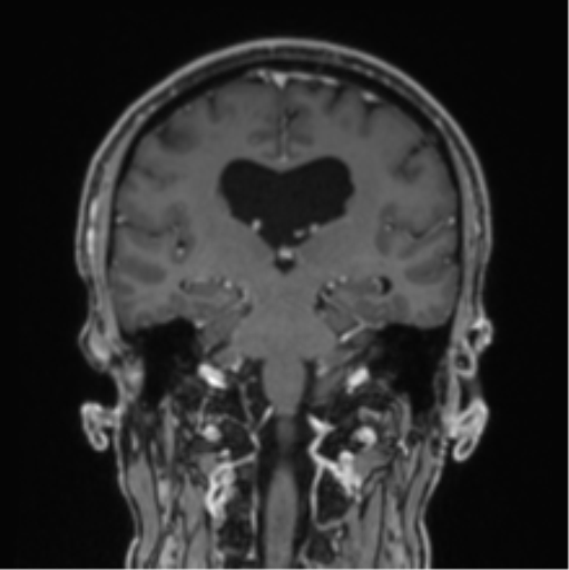 File:Colloid cyst of the third ventricle (Radiopaedia 86571-102662 Coronal T1 C+ 43).png