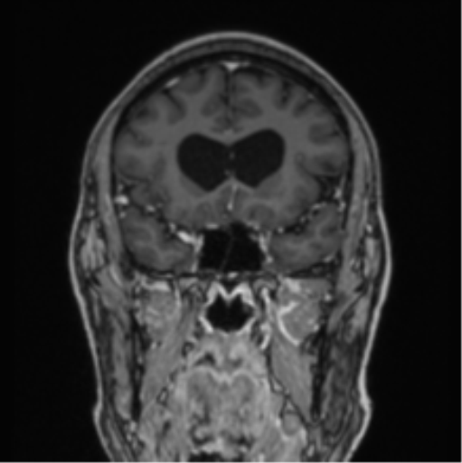 File:Colloid cyst of the third ventricle (Radiopaedia 86571-102662 Coronal T1 C+ 63).png