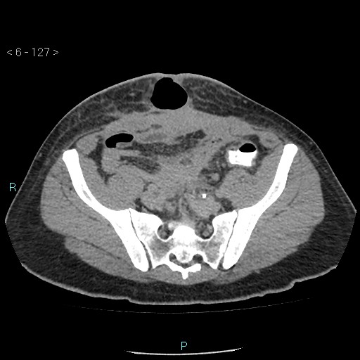 File:Colo-cutaneous fistula (Radiopaedia 40531-43129 A 53).jpg
