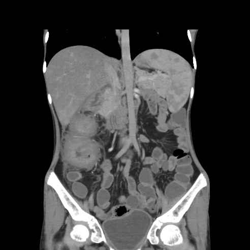 File:Colocolic fistula - Crohn disease (Radiopaedia 57063-63955 B 21).jpg