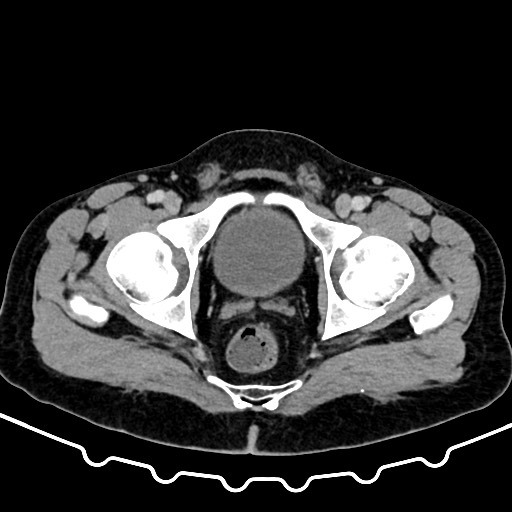 Colocolic intussusception due to large lipoma (Radiopaedia 68773-78482 A 184).jpg