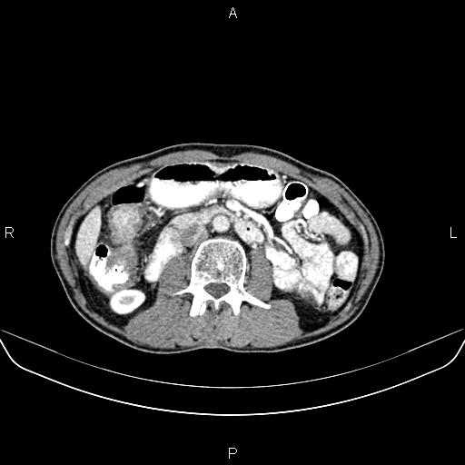 File:Colon adenocarcinoma - hepatic flexure (Radiopaedia 85635-101395 A 42).jpg